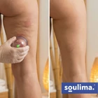 Kép 4/13 - Soulima 12 poharas vákuumos köpölyöző készlet